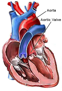 Aortic Valve Surgery - Heart Surgery - Raney Zusman Medical Group