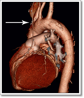 Coronary Artery Bypass Graft